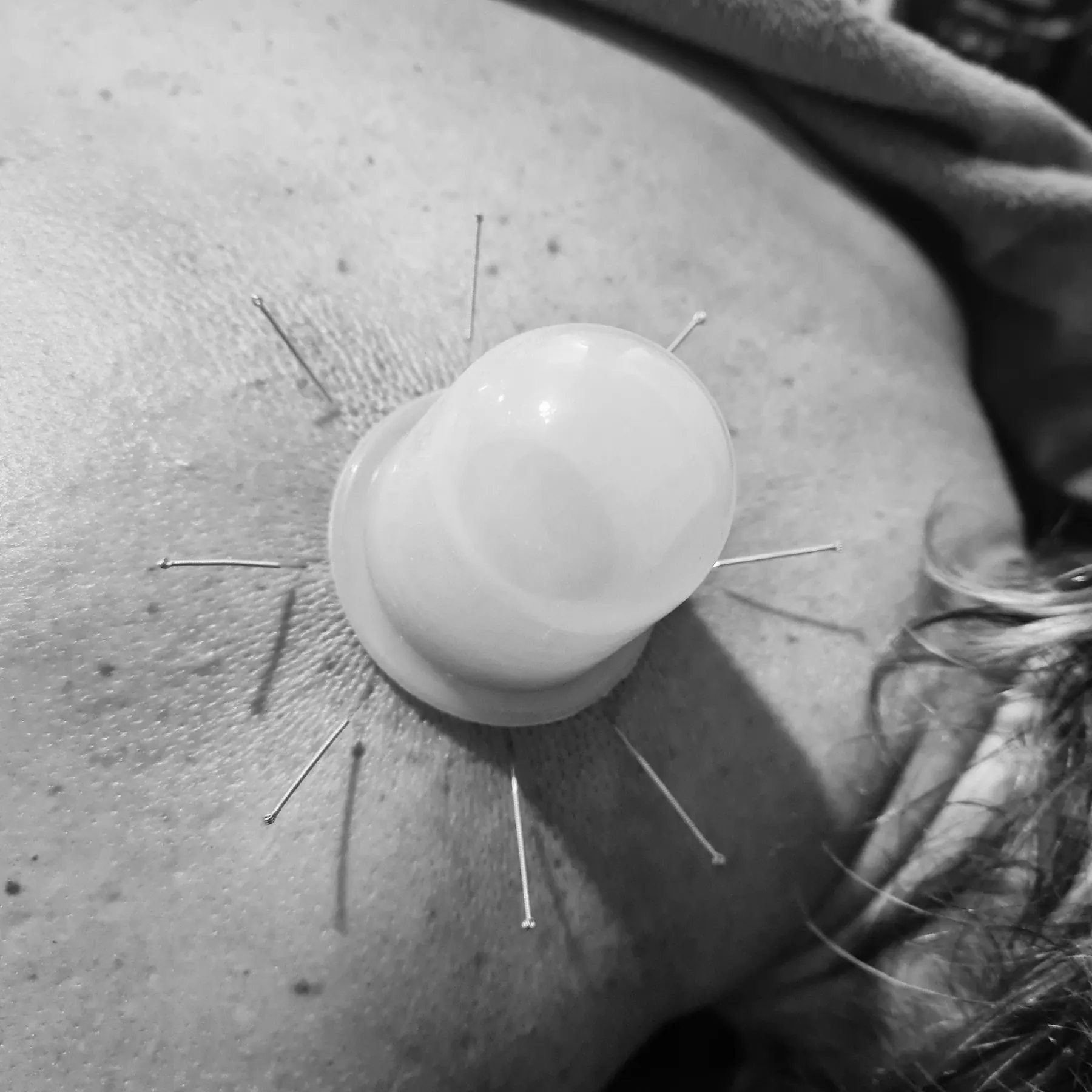 Cupping en acupunctuur bij massagepraktijk ALT voor rugpijn en stress