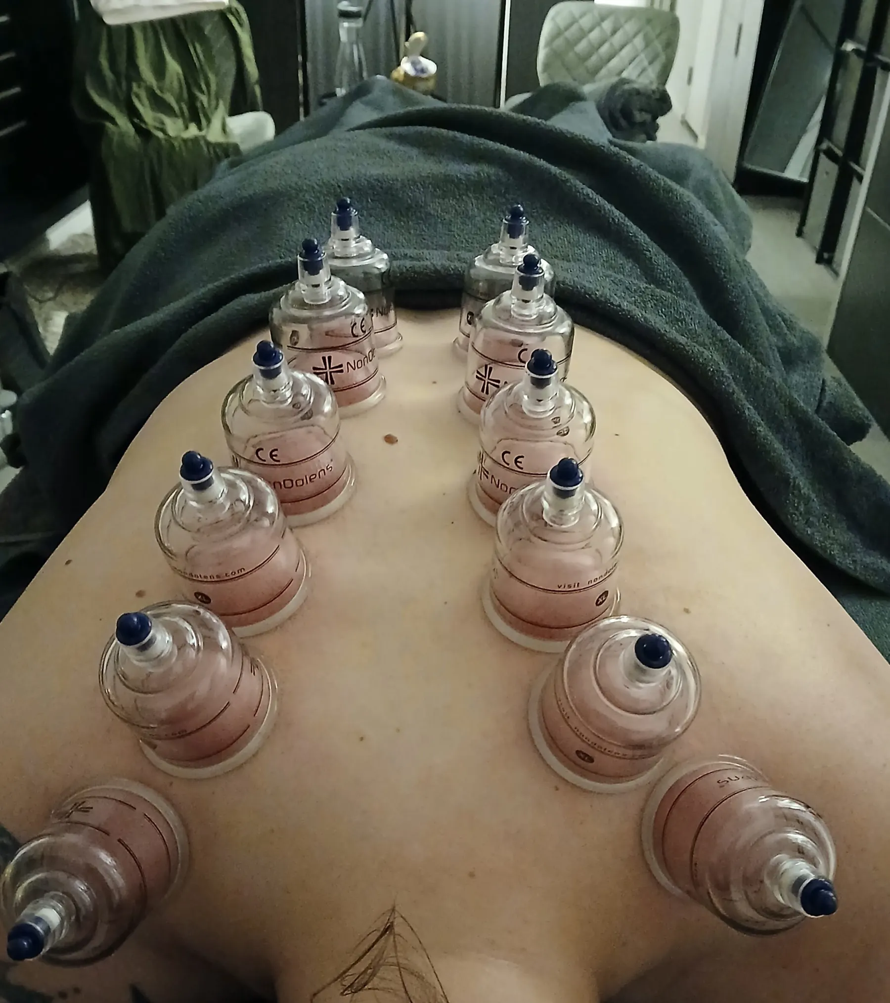 Cupping